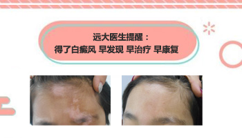 11岁女孩腿丫上有白癜风怎么办?”