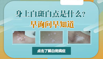 儿童晕痣型白癜风怎么治疗?”