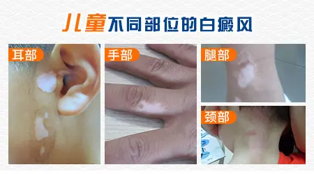 孩子太阳晒后脸上白斑是什么？详解与应对策略”