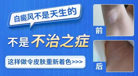 治疗白癜风打得宝松效果怎么样