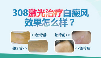 `小孩多年白癜风,服用口服药需注意的要点`