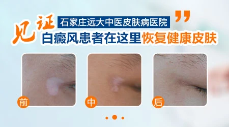 多年的白癜风照光有耐光性了怎么办