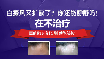 白癜风治疗中,新白斑还会在其他部位出现吗?”