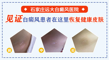 女性白癜风患者植皮术后,肤色能否回归自然?”