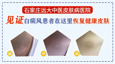 白癜风使用药物能治好吗？”