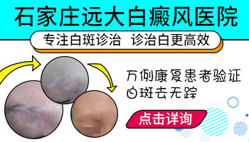 小孩头皮上长白癜风能长期照308吗”