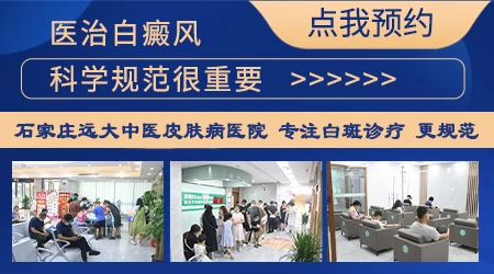 男性如何选择治疗白癜风的方法”