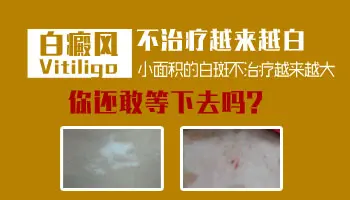 `女性白癜风患者该如何保养`