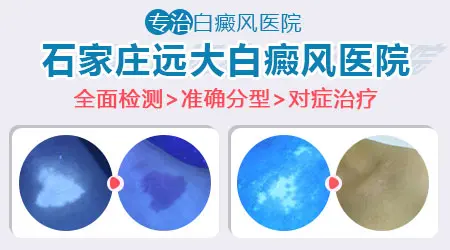 男性白癜风患者祛白需谨慎的两个问题