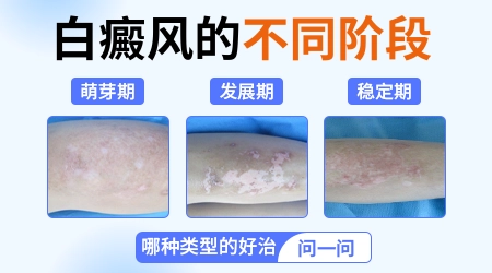 男性白癜风对备孕有无影响?白癜风遗传给下一代的概率大吗?”