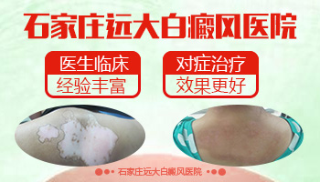 什么方法治小孩白癜风安全有效