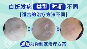 孕妇手臂出现一块白斑点是不是白癜风？”