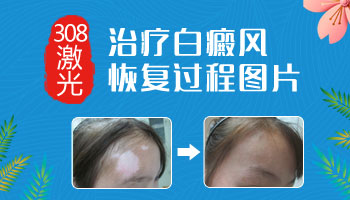 有效守护，避免儿童白癜风扩散的小妙招
