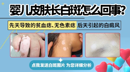 白癜风是否遗传给小孩?