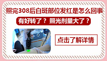 了解308光疗治疗小孩白癜风的大致费用”