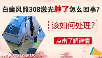小孩嘴周一圈的白癜风怎么治疗?