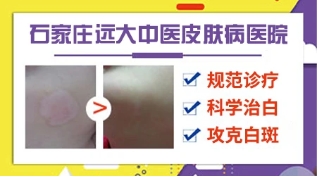 专为儿童设计:白癜风治疗优选医院指南”