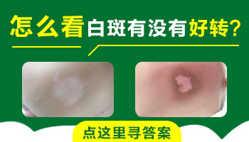 白癜风危害大盘点