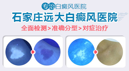 了解儿童白癜风:常见症状与识别指南”