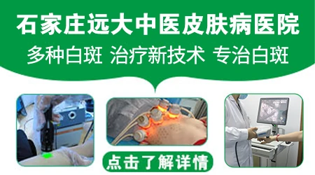 儿童脸部白斑照308激光一个月能恢复吗？
