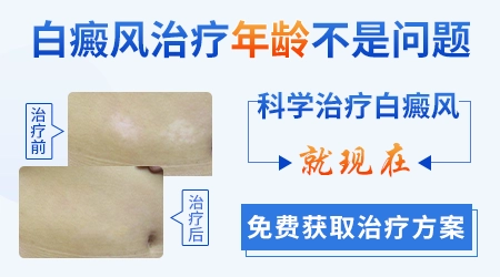 成年男性白癜风擦药一段时间后泛红是好转吗?