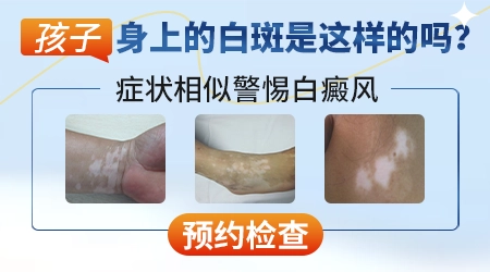 儿童眼眶白癜风做308激光后明显好转,还需继续照射吗?”