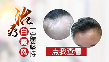 `隐藏白癜风症状的有效方法`