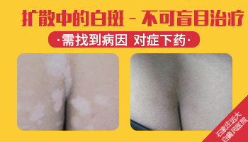 白癜风的治疗对经期有影响吗？