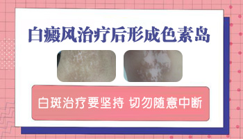 春季预防白癜风扩散的有效方法