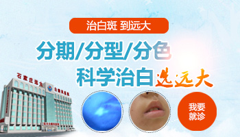 孩子脸上白癜风能用激光治吗?”