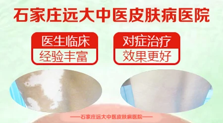 儿童白癜风越抹药越白怎么回事