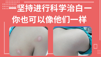 轻松辨别:孩子皮肤上的晒伤与白癜风有什么不同?”