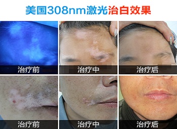 8岁小孩白癜风,哪些药物治疗更有效?”