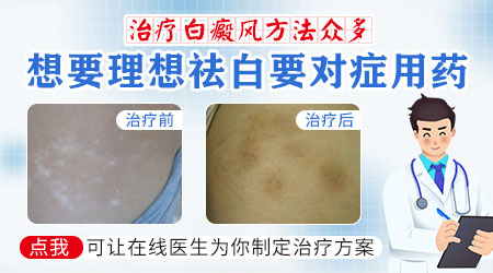 女生身上长白癜风怎么治疗效果好