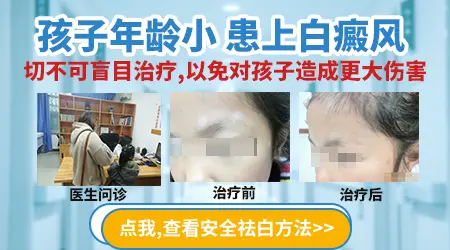 孩子白癜风康复后,遗传因子还会存在吗?