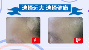 孕期白癜风，会遗传给宝宝吗？