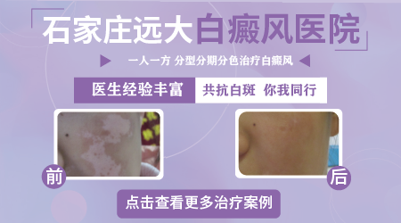 孩子白癜风打完308激光皮肤发红两天会消失吗?”