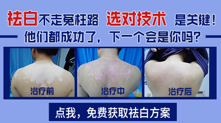 十四岁女孩脸上为何出现白斑？专业解答来了！”