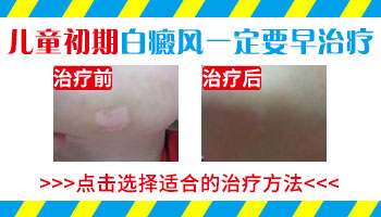 孕期能否检测孩子是否遗传白癜风?