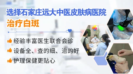 女性面部白癜风,如何选对治疗药物?”