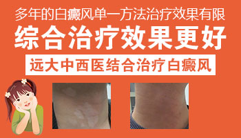 寒假期间孩子的白癜风如何有效治疗”