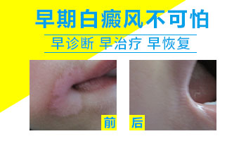 怀孕期间长白癜风产后再治会耽误病情吗？”