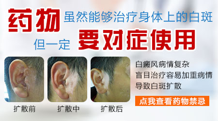 更换白癜风治疗药物需谨慎：全面了解，科学决策”