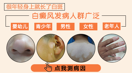 确保白癜风快速治疗的好方法有哪些”