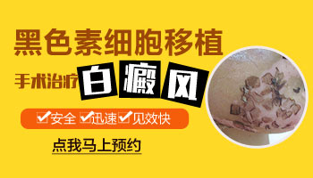 脸上白癜风的治疗方法详解