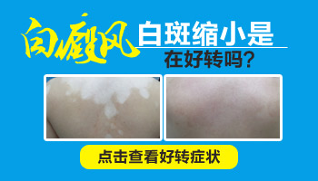 女性白癜风如何治疗效果好？专业解答与日常建议”