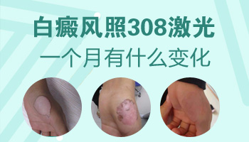 小孩8岁长白点不痛不痒是白癜风吗?