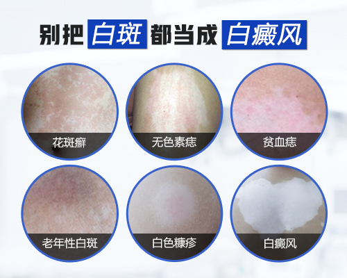儿童头部巴掌大白斑照308激光能治好吗