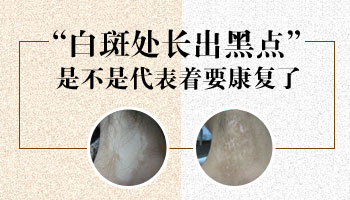 儿童肩膀巴掌大白斑照激光效果不明显怎么回事