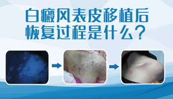 儿童腿上有白块中西医结合治疗怎么样